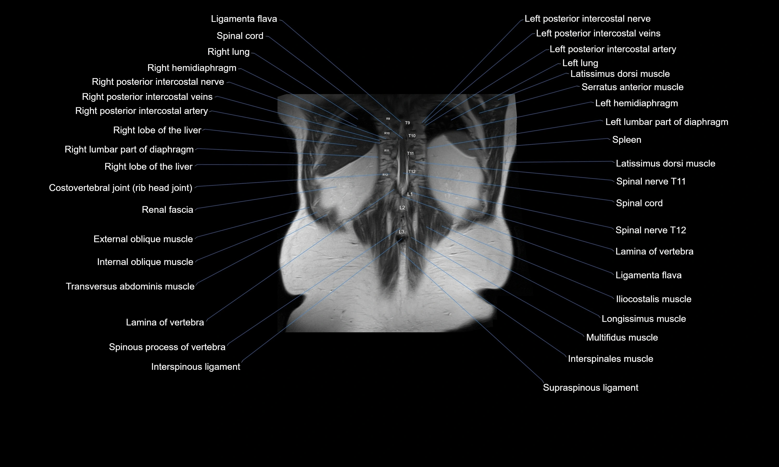 MRI Abdomen axial cross sectional anatomy radiology  image-img-00001-00050.webp
